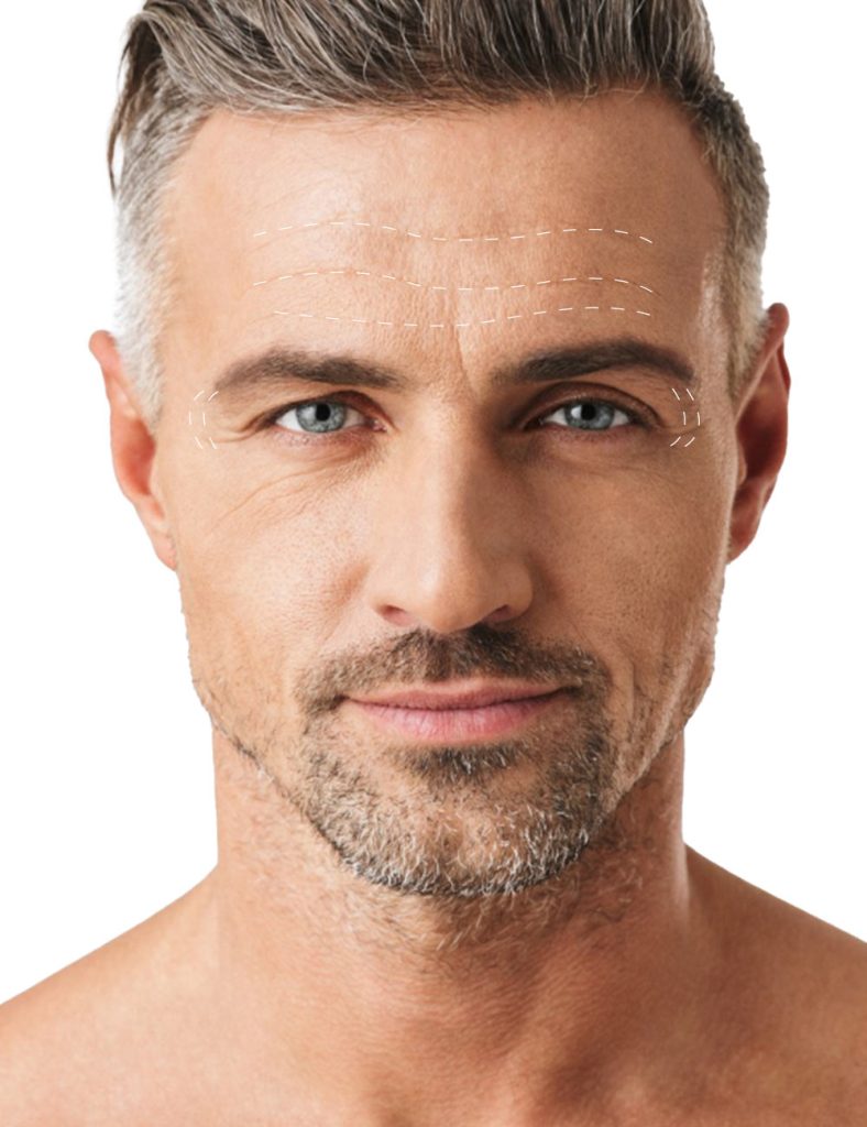 BOTOX TOTAL FOR MEN – Renaissence-Online